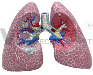 Diseased Lung